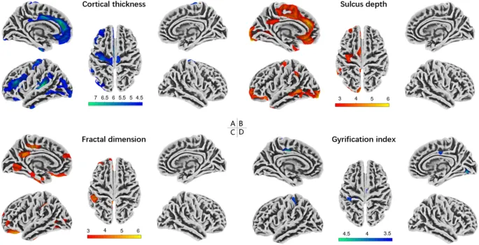 Рисунок 1: Изменения толщины коры у пациентов с пЭД