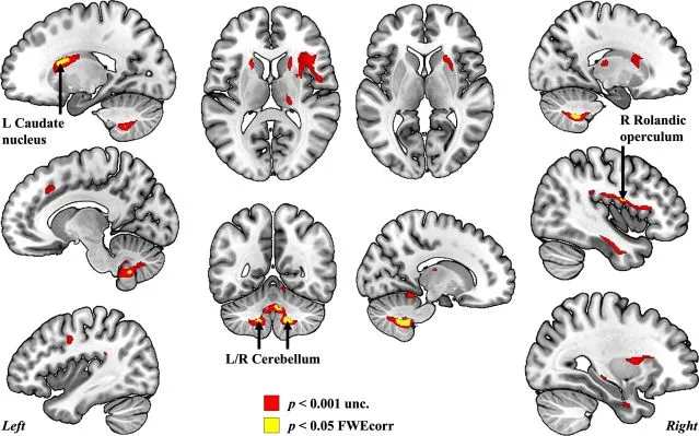 Источник: Marie et al., 2023 / Neuroimage: Reports (CC BY 4.0)