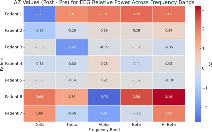 Рисунок 5: Тепловая карта ΔZ-оценок в относительной мощности ЭЭГ по частотным диапазонам после NF-тренинга. Каждая строка представляет пациента; столбцы соответствуют диапазонам частот Дельта, Тета, Альфа, Бета и Высокая Бета. Теплые цвета (красный) указывают на увеличенное отклонение от нормативного среднего (положительное ΔZ), в то время как прохладные цвета (синий) отражают уменьшенное отклонение (отрицательное ΔZ). Значения |ΔZ| ≥ 2 обычно интерпретируются как клинически значимые в анализе qEEG.