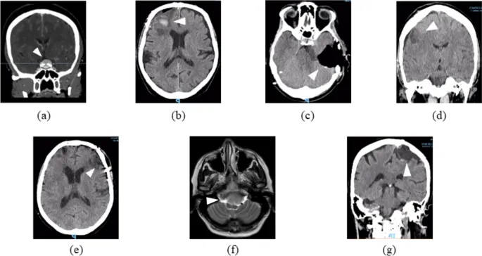 Рисунок 2: Предоперационная нейровизуализация пациентов с опухолями головного мозга, проходящих NF-реабилитацию. Легенда: a Пациент 1: Акссиальная КТ-скан, показывающая менингиому бугорка седла (стрелка). b Пациент 2: Коронарная КТ, показывающая левую переднюю парасагиттальную менингиому. c Пациент 3: Коронарная КТ правой петрокливальной менингиомы. d Пациент 4: Акссиальная КТ, изображающая левую оперкулярную глиому. e Пациент 5: Акссиальная КТ-скан правой лобной менингиомы с кровоизлиянием. f Пациент 6: Коронарная Т2-взвешенная МРТ менингиомы foramen magnum. g Пациент 7: Коронарная КТ-скан правой роландической менингиомы. Примечание: Стрелки указывают на локализацию поражения. Изображения зеркально отражены для удобства чтения. Все изображения анонимизированы и используются с согласия пациентов.