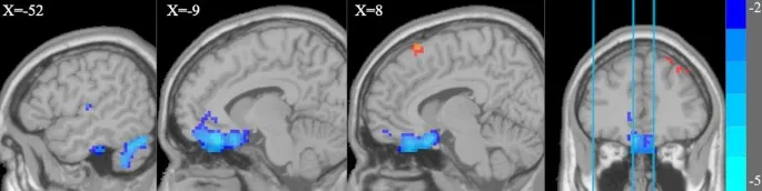 Рис. 2. Значение mALFF в группе IGD значительно снижено в области мозга. Синие вертикальные линии представляют X = -52, X = -9 и X = 8