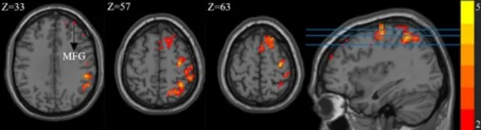Рис. 1. Значение mALFF в группе IGD значительно повышено в области мозга. Черная стрелка указывает на среднюю лобную извилину, а синие горизонтальные линии представляют Z = 33, Z = 57 и Z = 63. MFG, средняя лобная извилина