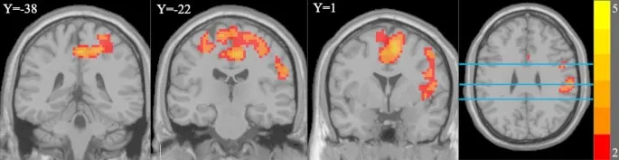 Рис. 4. Области мозга с повышенной FC MFG в группе IGD. Синие горизонтальные линии представляют Y = -38, Y = -22 и Y = 1