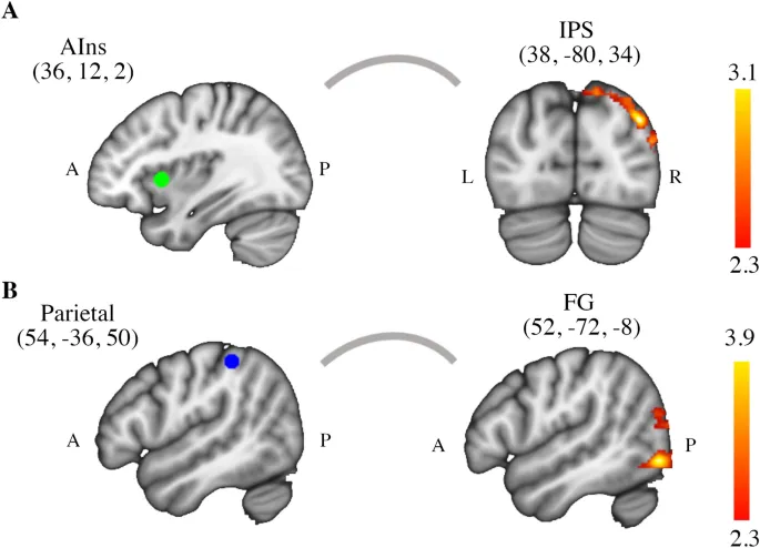 Рис. 3: Анализ психофизиологического взаимодействия (PPI) для передней островковой доли (AIns).